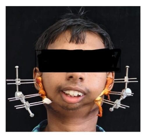 जटिल सर्जरी से खुला मुंह, आयुष्मान योजना से मिला निःशुल्क उपचार जटिल सर्जरी से खुला मुंह, आयुष्मान योजना से मिला निःशुल्क उपचार
